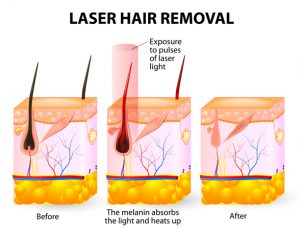 Describing laser hair removal procedure