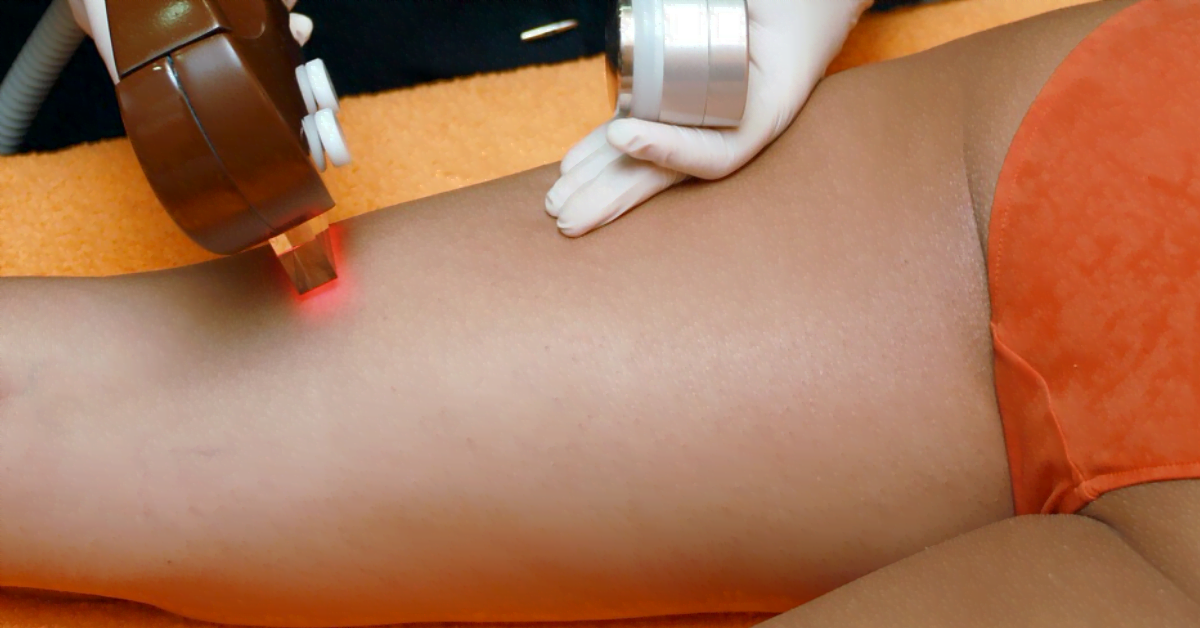 Full body laser hair removal