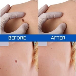 Skin tag removal pen results